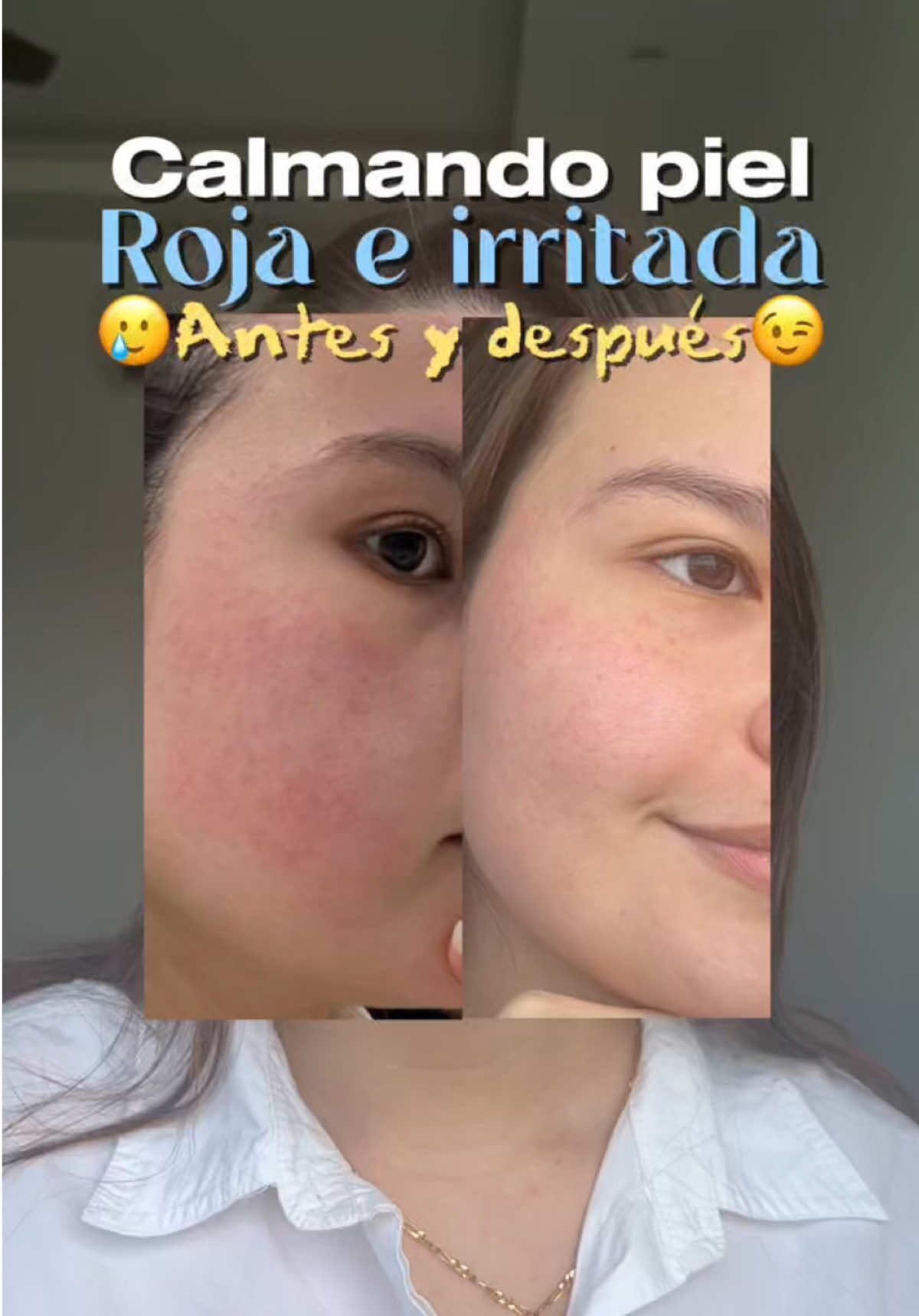 Vean como calmo mi rosácea en unos días con resultados de antes y después! 🫣✨ 🩵YesStyle -% code: ALEXINCOKOR1🩵 @YesStyle @anua_global @YesStyleInfluencers #YesStyle #yesstyleinfluencers #anua #sensitiveskin #rosaceaskincare 