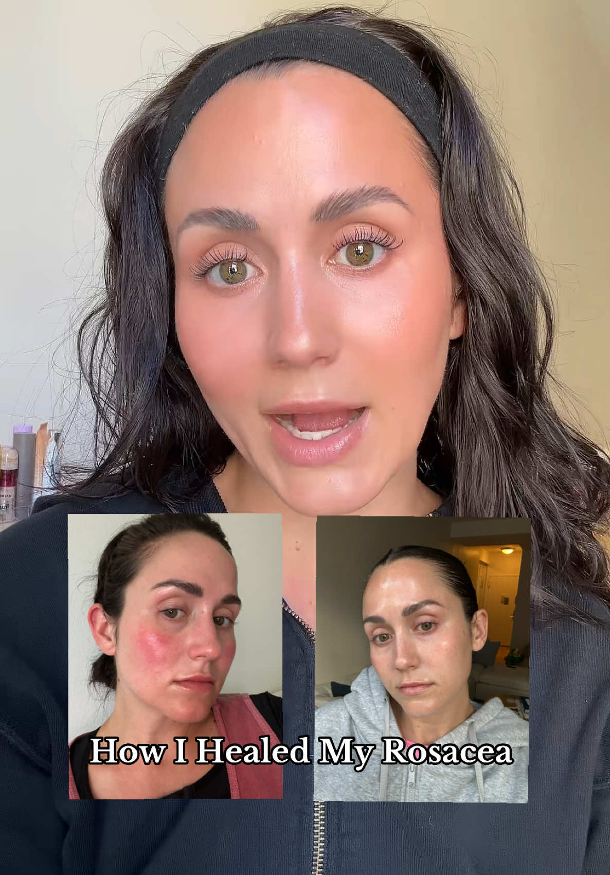 How I healed my rosacea on my own with 3 easy steps! 