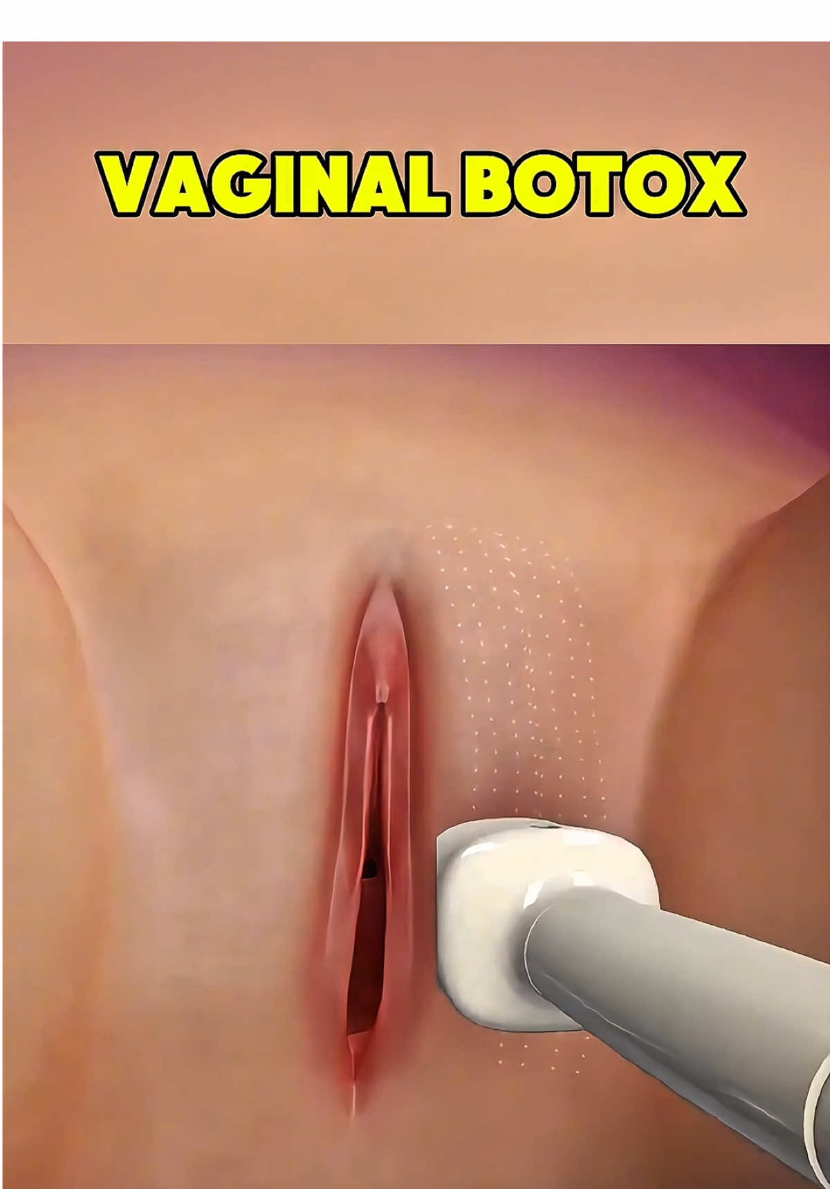 Vaginal Botox Ever wondered how women restore comfort and confidence in intimate areas? Vaginal Botox might be the surprising solution you haven’t heard about. This video is for educational purposes only and is not a substitute for professional medical advice. Consult a licensed healthcare provider before considering any procedure. #WellnessTips #HealthAwareness #Botox  #USA  #MedicalEducation