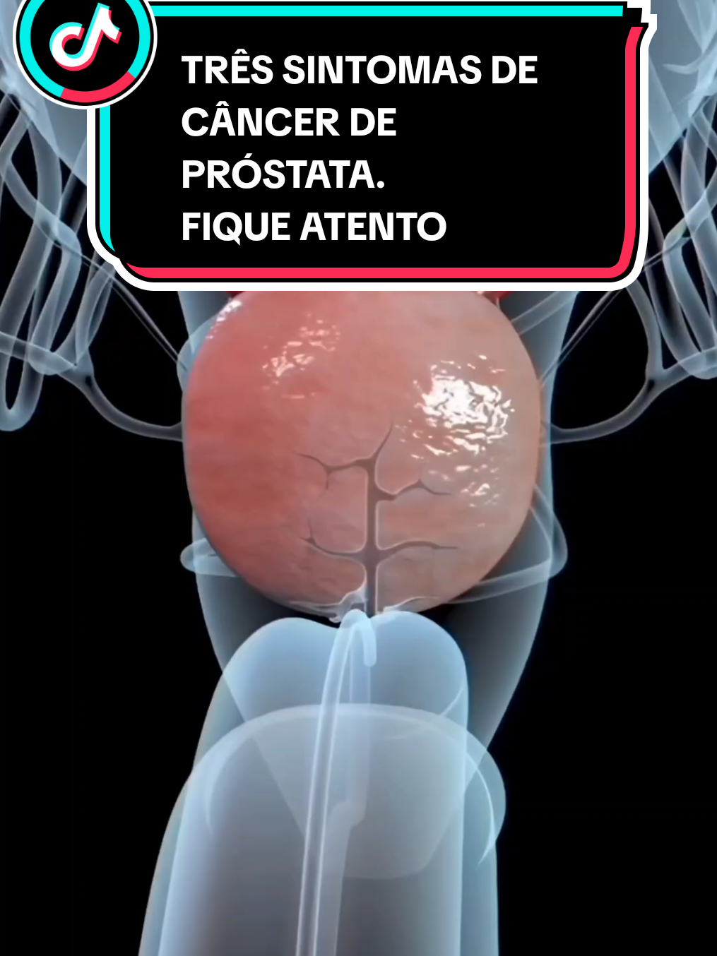 TRÊS SINTOMAS DE CÂNCER DE PRÓSTATA.. #sintomas  #doenca 