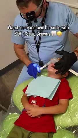 Why do his teeth look black? 🤔  That’s Silver Diamine Fluoride (SDF) a treatment we placed two weeks ago to stop the cavities and reduce harmful bacteria in his mouth! Now, we’re prepping his teeth for strip crowns: ✨ Tooth-colored and natural-looking ✨ Strong enough to protect baby teeth until adult teeth arrive ✨ A safe, comfortable option for restoring smiles 👉 In Part 2, you’ll see us place the crowns 