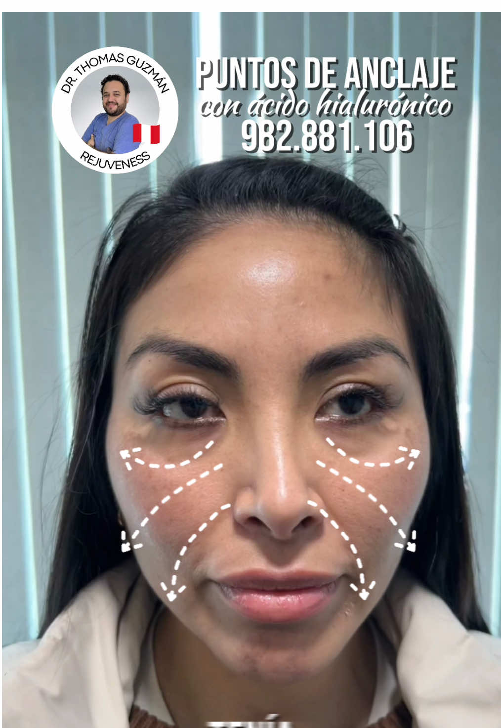 💉✨ ¿Buscas un lifting natural sin cirugía? Los puntos de anclaje con ácido hialurónico redefinen y devuelven firmeza a tu rostro con resultados sutiles en tan solo 30 minutos. Un procedimiento seguro, realizado por médicos expertos, que realza tu belleza sin cambiar tu esencia. 📞 Agenda tu cita al 982.881.106 o 915.110.746 #PuntosDeAnclaje #ÁcidoHialurónico #RejuvenessBeautyCare #LiftingNatural #FacialRejuvenation #GlowUp #Lima #Miami #Florida #NewJersey #NewYork #Utah