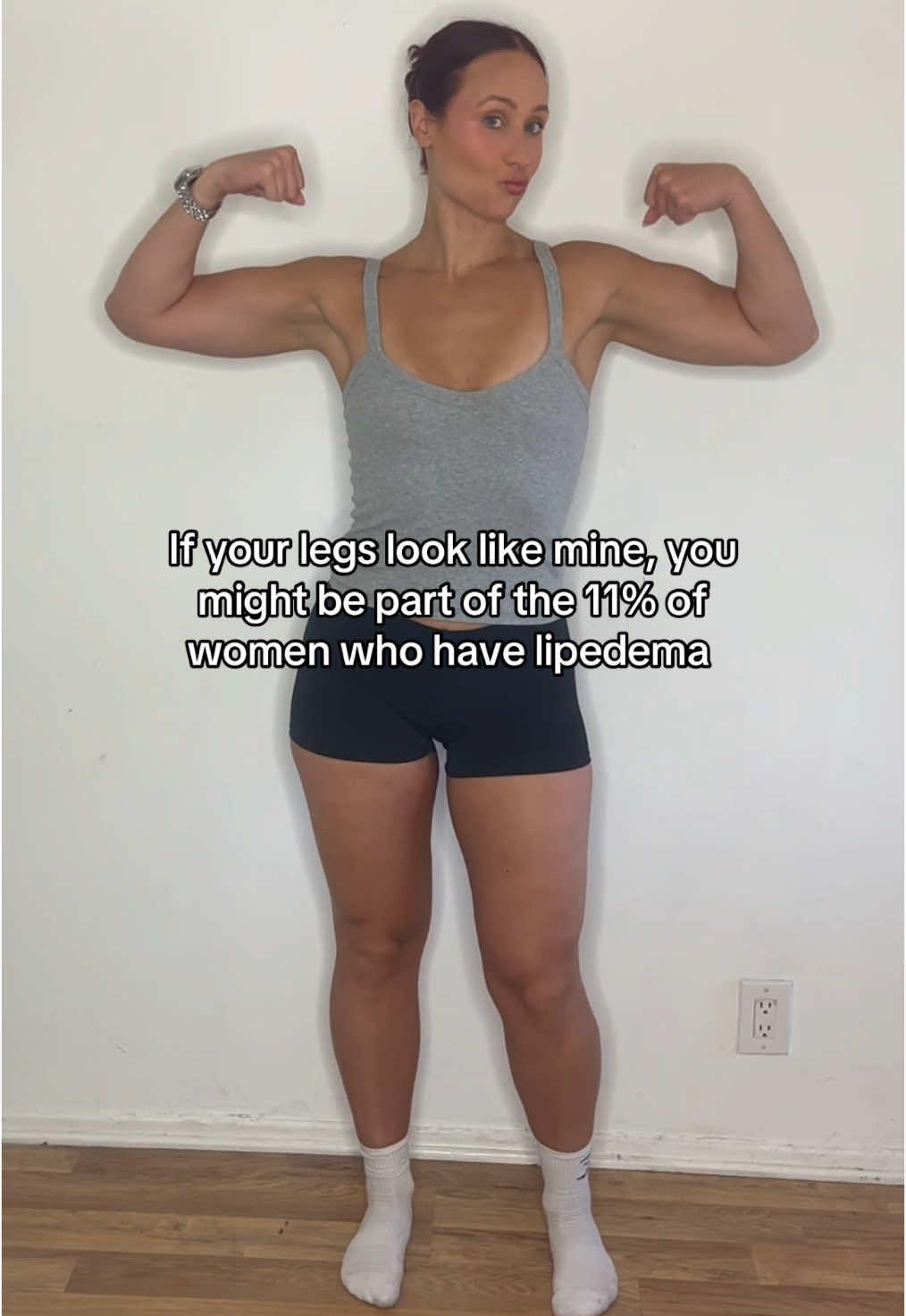 11% (or more!) of women deal with lipedema just like me - and if you said “yep” to all or most of these symptoms then I want you to know you’re not crazy and you’re not lazy. It’s a medical condition that needs WAY more awareness to it! #lipedemalegs #lipedema #lipedemafighter #lipedemalife #lipedemaawarenes 