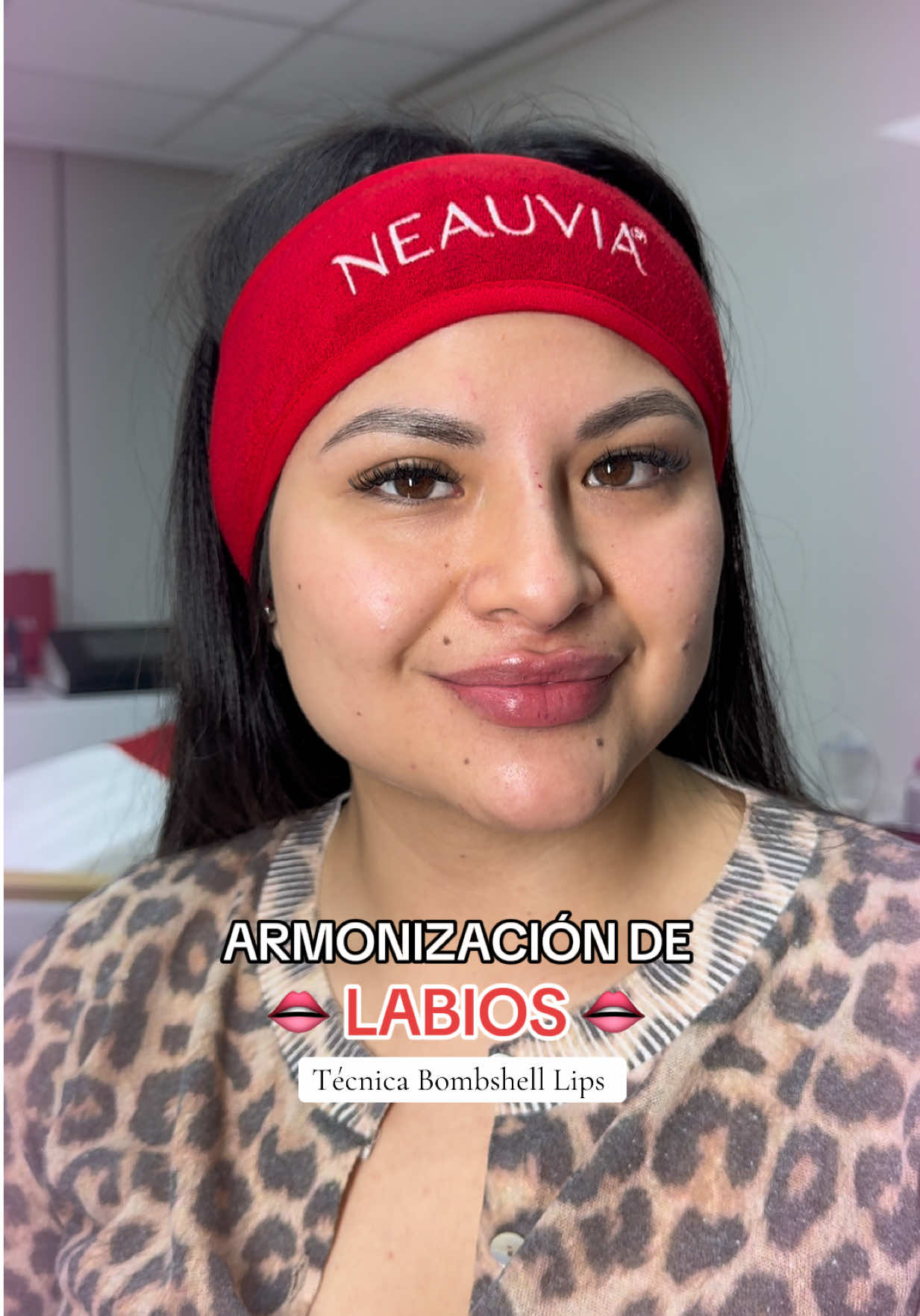 Unos labios que transmiten felicidad 💖🤩 #lips #labios #filler #aumentodelabios 