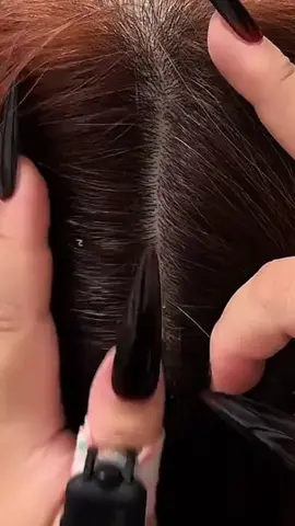 #foryou #dandruff #dandruffsolution 