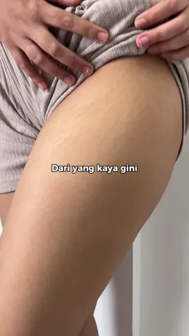 Emang boleh sepudar ini?!🥰Ciara Stretch Marks Booster Cream membantu pudarkan stretch marks dari hari ke hari✨ Join live sekarang buat dapetin harga termurah‼️ #ciaraindonesia #ciara #stretchmark #stretchmarks #fyp 