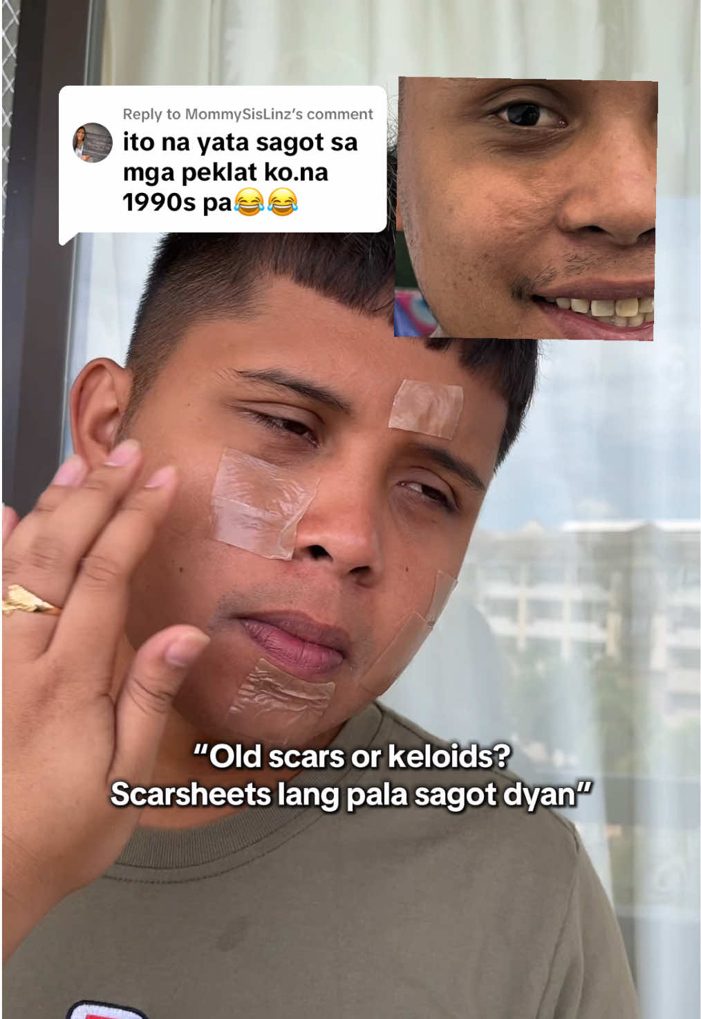 Replying to @MommySisLinz even yung pimple scars niya tignan niyo nagfefade na  #scarsheets #scars #siliconescarsheets 