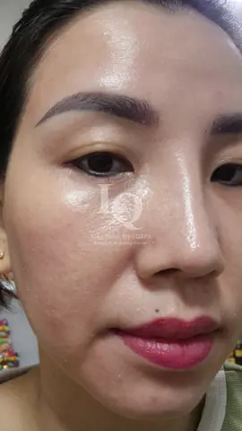 Cập nhật da sạm  #chamsocdaseo#chamsocda#chamsocdamun#chamsocdanam#tanbinh             