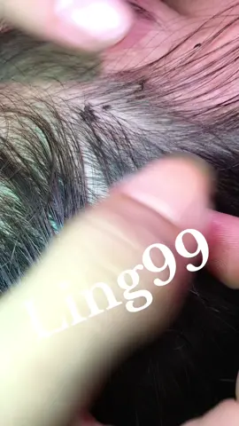 Remove lice #omg😘😘😘😍😍😻😻😽😽🥳🥳😂😂😂 #liceremoval #lice 