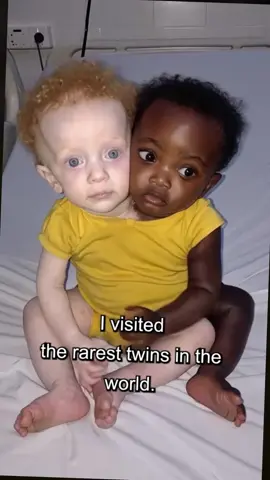 Ho visitato i gemelli più rari del mondo, e non crederai a ciò che ho visto. 
 #storia #imparacontiktok #imparacontiktok 