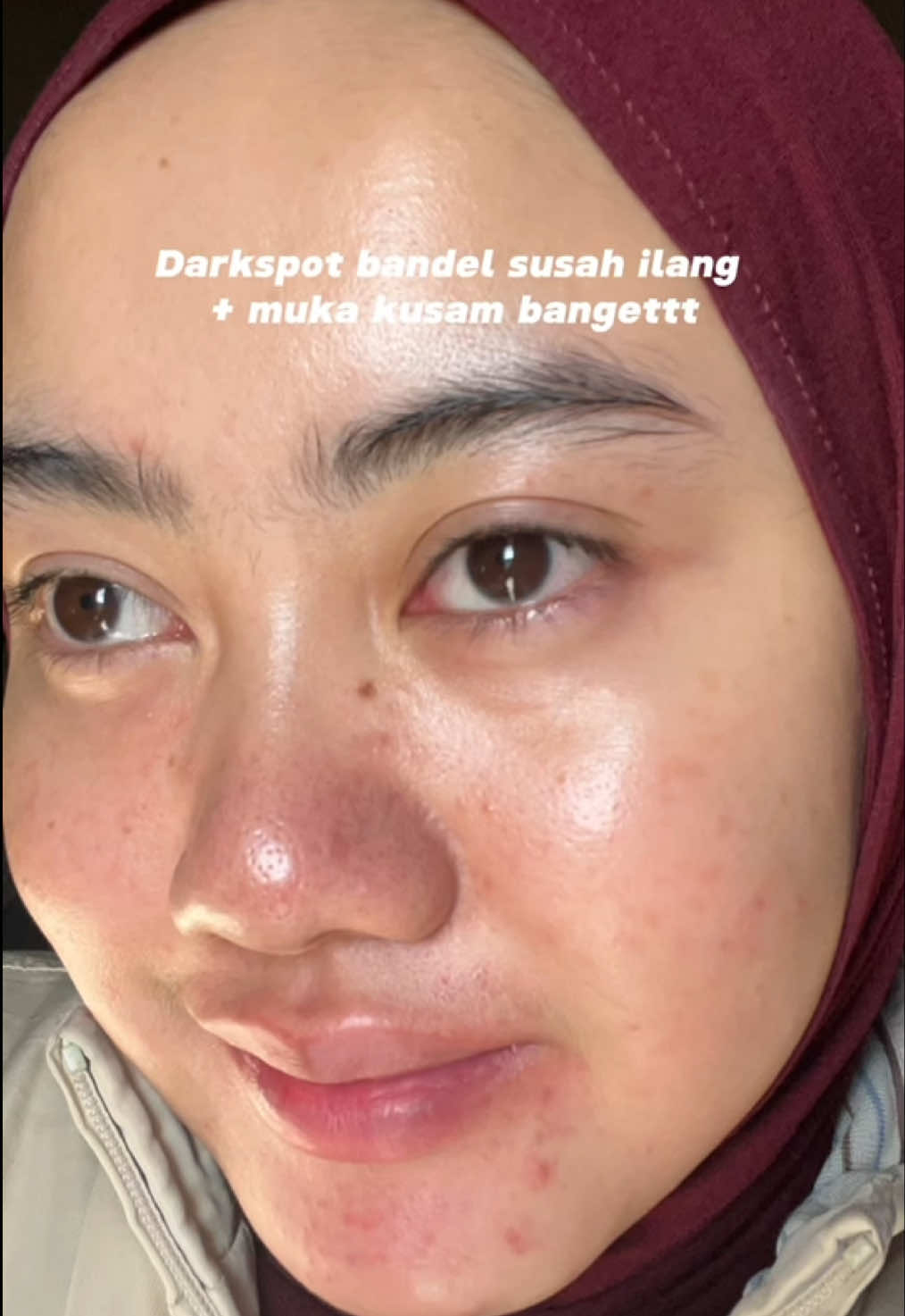 Jujur ternyata exfoliate pake ini tuh bikin breakout aku membaik karna type nya kan closed komedo gtu kann nahh bisa banget bikin kulit semulus ini 🥹😍 #elsheskin #exfoliateyourskin 