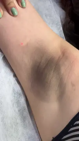under arms carbon laser  book your appointment  📞 03244460818 #carbonlaser #good #foryoupage #viralvideo #viralreels 
