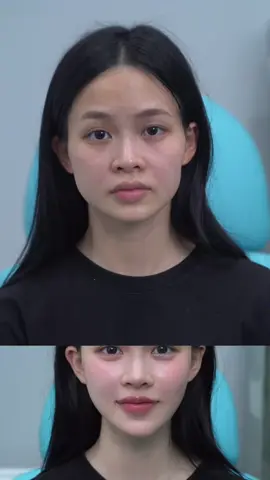 HA sẽ cho bạn trẻ đẹp như thế nào …Nâng tầng mặt giữa trẻ hoá #làmđẹptrunghoa #douyin  #nângcơtáo 