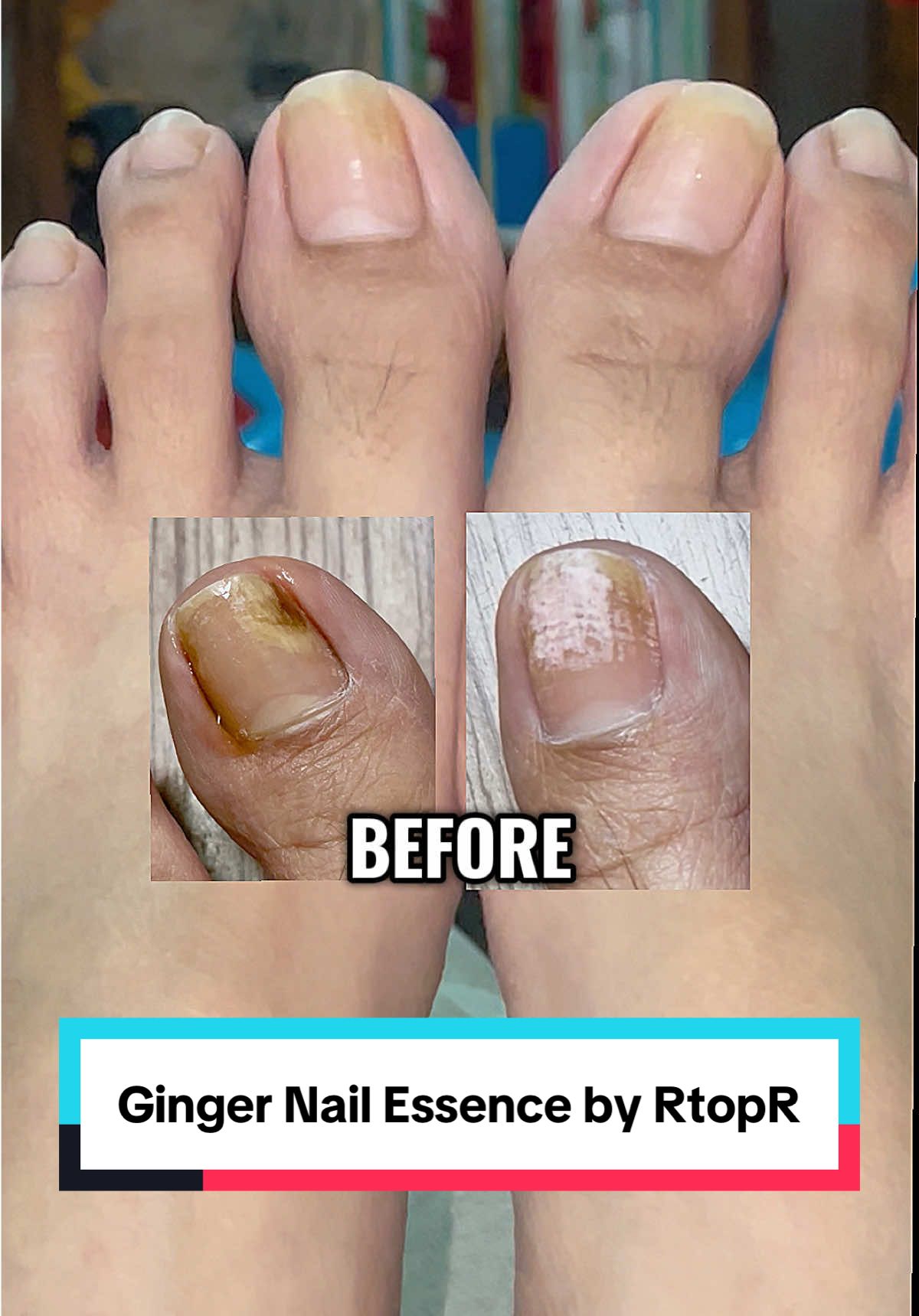 Gentle yet powerful — treats nail fungus while nourishing and strengthening.  One solution for fungus, damaged nails, and brittle tips — Ginger Nail Essence. #gingernailessence  #nailcare  #nailrepair  #nailfungustreatment  #fyp 