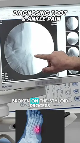 Twisted ankle? It could be more than a sprain! 🔹 A patient came to us after twisting her ankle and was diagnosed with a styloid process fracture, a small but painful break. This type of injury needs proper care to heal correctly and prevent long-term issues. 🔹 At Best Foot Doctor NY, we provide expert diagnosis and personalized treatment plans to get you back on your feet safely and quickly. Don’t ignore ankle pain after a twist or injury! ➡️ Learn more about our treatments: bestfootdoctorny.com #BestFootDoctorNY #AnkleInjury #StyloidProcessFracture #FootCare #Jamaica #PodiatryExperts