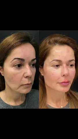 Paciente de Boston 🇺🇸 Ela se incomodava com o aspecto de derretimento facial e nós fizemos o tratamento de harmonização facial para melhorar as estruturas do rosto e resgatar a autoestima!
