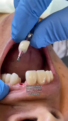 Assim que se coloca uma coroa cerâmica parafusada sobre implante! Faz sentido vir numa avaliação? #odontologia #implantes #implanteszigomaticos #dentista #prótesedentária 