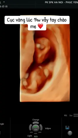 Hình ảnh em Bon lúc 14w của mẹ. Trộm vía lần nào đi siêu âm các chỉ số của em đều tốt ❤️#embon #mangthai #mebau #bena2025🐍 #xuhuong 
