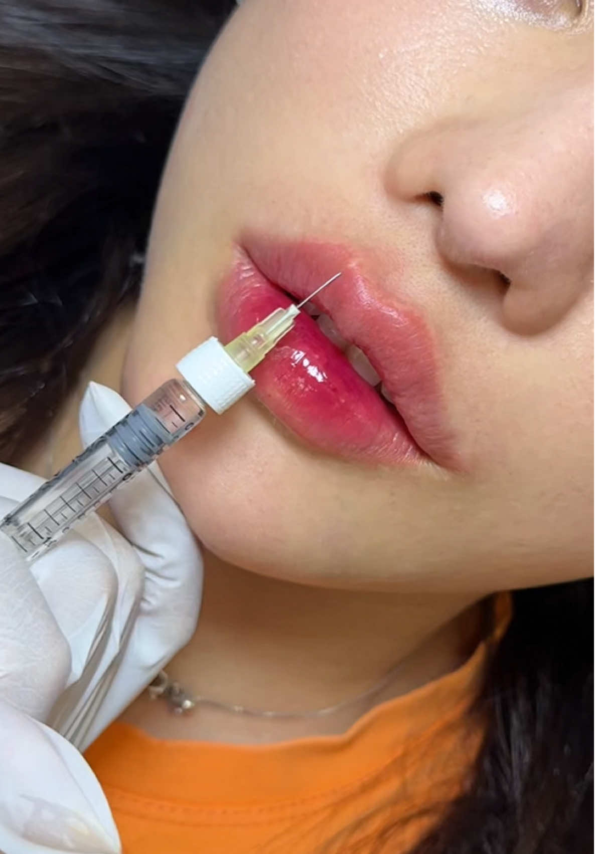 Mặt đẹp đâu cần phải chỉnh, nhưng Môi đẹp thì cần nha 😎#tiemmoi 