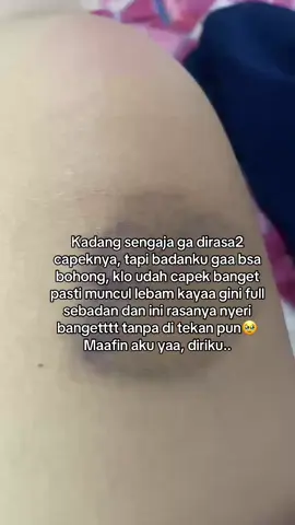 Kalo udah muncul lebam bgini gaa bsaa tdur semaleman karna badannya pasti nyeri banget🥹🥲 #fyp #batam #autoimmune #tiktok #doyourmagic 