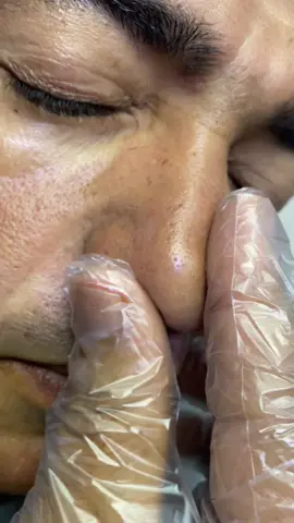 ازالة الدهون الانف بالثلج 😳😳😳#حسن_شاهين #نادي_الرجال_السري #مصر #شعب_الصيني_ماله_حل 