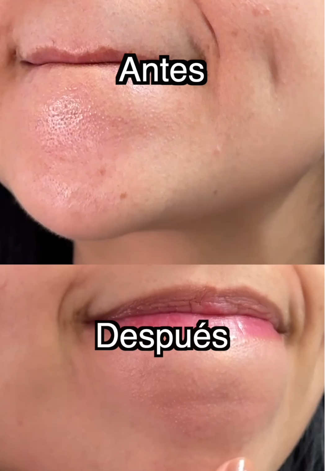 Pensé que solo el sérum de niacinamida lo solucionaría… pero no fue suficiente. Luego probé este nuevo hallazgo de K-Beauty: la Barra Facial de Niacinamida de Marsmade. En solo 2 semanas, mi problema de piel con textura se fue. ¡Lo borró por completo con esta barra en forma de M! #Marsmade #MFaceBar #Niacinamide #parati #cuidadofacial 