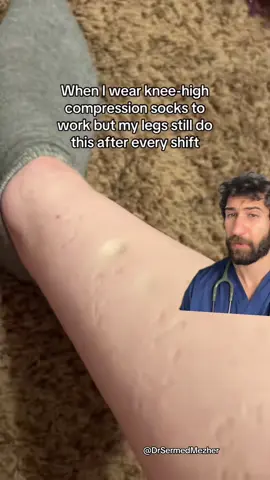 “It’s Like This After Every Shift” #why Source: @autismjesus Pitting oedema in the legs is when pressing on swollen skin leaves an indentation that lingers for a few seconds. In some cases, it can be relatively innocent — for example, after standing for long periods, sitting on long flights, or during pregnancy, when fluid naturally collects in the lower limbs. These situations are often temporary and improve with rest, elevation, or gentle movement. However, pitting oedema can also be a sign of something more serious. It may point to underlying heart failure, kidney disease, or liver problems, all of which interfere with the body’s ability to manage fluid balance. It can also signal issues like deep vein thrombosis or chronic venous insufficiency. Because the causes range from harmless to potentially life-threatening, persistent or unexplained leg swelling is something that should be checked by a doctor to rule out more serious underlying conditions. #legs #swelling #health 