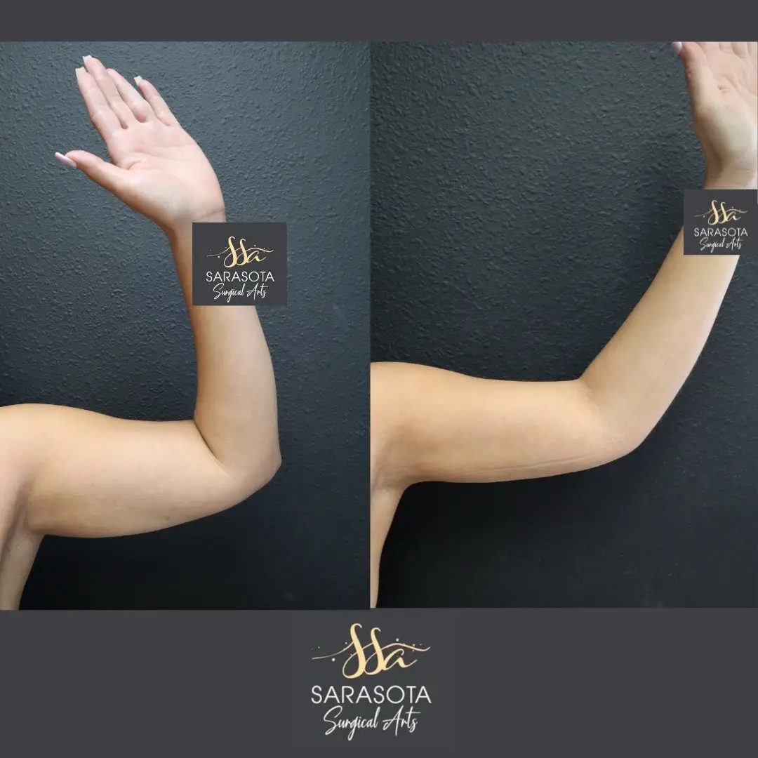Procedure: Arm liposuction Sarasota Surgical Arts Book your consult now! DM us or call 941-923-1736 #armlipo #liposuction #cosmeticsurgery #sarasota #cosmeticsurgeon