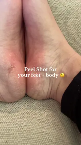 So like this is insane 🫣 The kojic acid, turmeric, and niacinamide work together to exfoliate the skin leaving behind clearer more even skin. @Dr Melaxin Official  #drmelaxin #peelshot #exfoilating #skincare #tiktokshoplabordaysale 