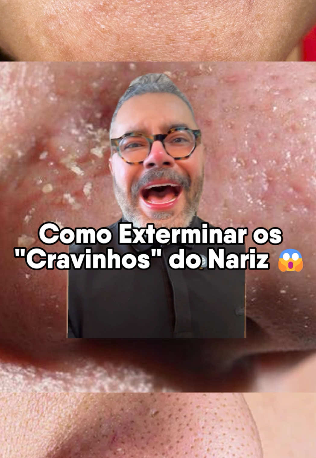#filamentossebaceos #cravoseespinhas #cravos #cravossatisfatorios #skincarebrasil 