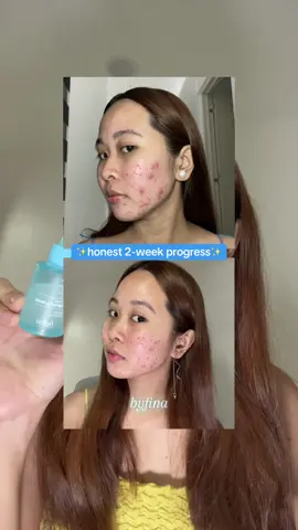 dahil sa’yo byfina, nag brighten talaga yung skin ko and calm yung acne kooo😭🩵 #byfina #byfinaserum #byfinaph 