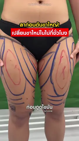เปลี่ยนขาใหญ่ เป็นขาใหม่ ในไม่กี่ชั่วโมง#masterpiecehospital #หมอฟลุ๊คมาสเตอร์พีช #masterpiece #fyppppppppppppppppppppppp #liposuction 