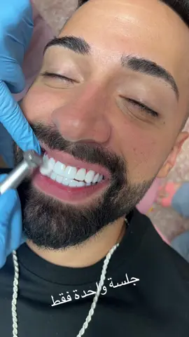 #compositeveneers #explorepage #luxurysmile #lebanontiktok #fypage 