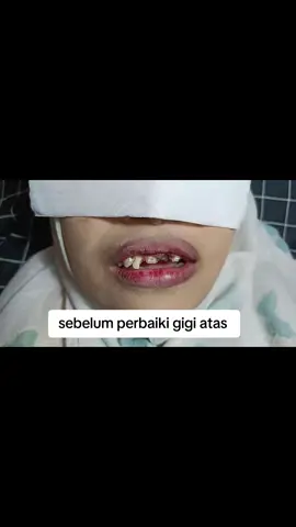 Hasil perbaiki gigi atas langsung pasang GIGI KELINCI GIGI GINGSUL