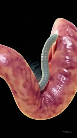 Endoscopia nunca más: alivia gastritis y reflujo con té casero #endoscopia #gastritis #reflujo #acidez #remedionatural 