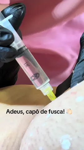 Fica até o final para ver o resultado…  Sabia que podemos eliminar o famoso capô de fusca com um procedimento em consultório? Sem cirurgias?  Se você tem dúvidas ou interesse sobre os esvaziadores de gordura, me chama aqui!  #ginecologia #capodefusca #gorduralocalizada #esteticaintima #saopaulo 