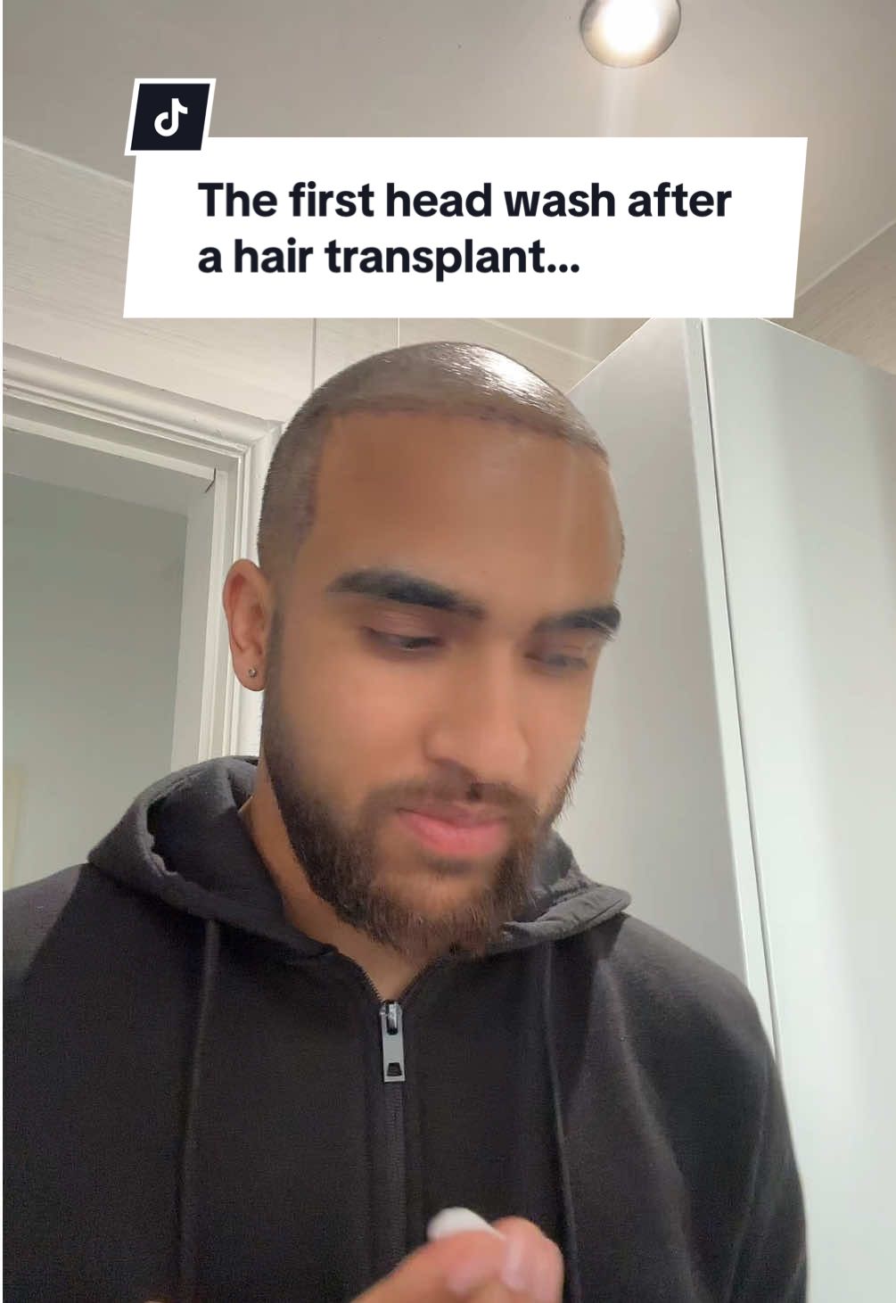 The first head wash after a hair transplant… #drozlembicer #hairreconstruction #hairtransplant #hair 