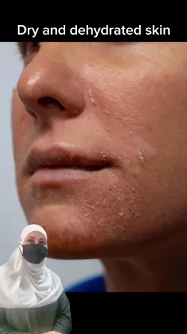#dryskin #oilyskin #age #dramira 