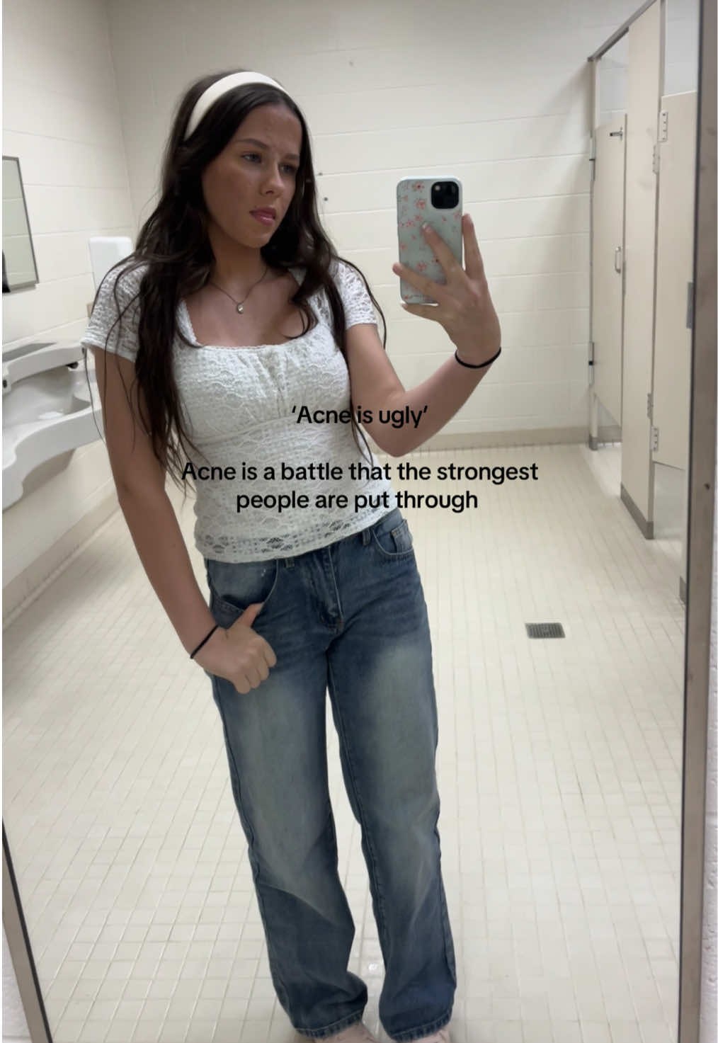 #skinpositivity #acnepositivity #acneawarness #acnestruggles #foryoupage 