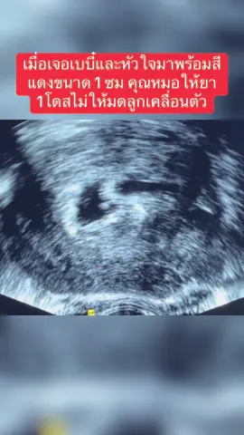 เจอเบบี๋และหัวใจพร้อมสีแดงออกขนาด 1 ซม เนื่องจากแม่ฉีดยาป้องกันเลือดแข็งตัวอาจจะทำให้หยุดยากกว่าคนอื่นๆ #บำรุงก่อนตั้งครรภ์ #icsi #เตรียมผนัง #ใส่ตัวอ่อน 