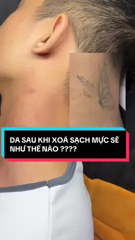 Đã sạch mực cho bạn khách. #xoaxamuytin #xoaxamlaserpico #xoaxamhanoiuytin #Gianganhxoaxam #dasaukhixoaxam 