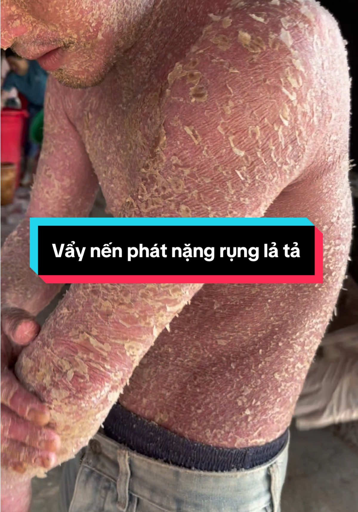 Vẩy nến phát nặng trên người anh toàn vẩy #vaynen #viemdacodia @Thị tuyến dc 35 