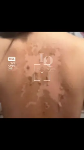 Cập nhật da mụn lưng #chamsocdamun#chamsocdanam#chamsocdaseo#lequynhspa#hocnghespa 