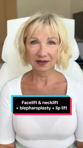 62 years old patient, 3 months after deep plane facelift, deep necklift, upper blepharoplasty and lip lift🤩 All done under local anesthesia👌 📲If you want to make an appointment, contact us at contact@v-clinic.cz #facelift #necklift #blepharoplasty #plasticsurgery