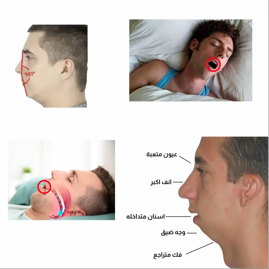 إذا ماتبي هاذي الأعراض تجيك وقف تتنفس من فمك