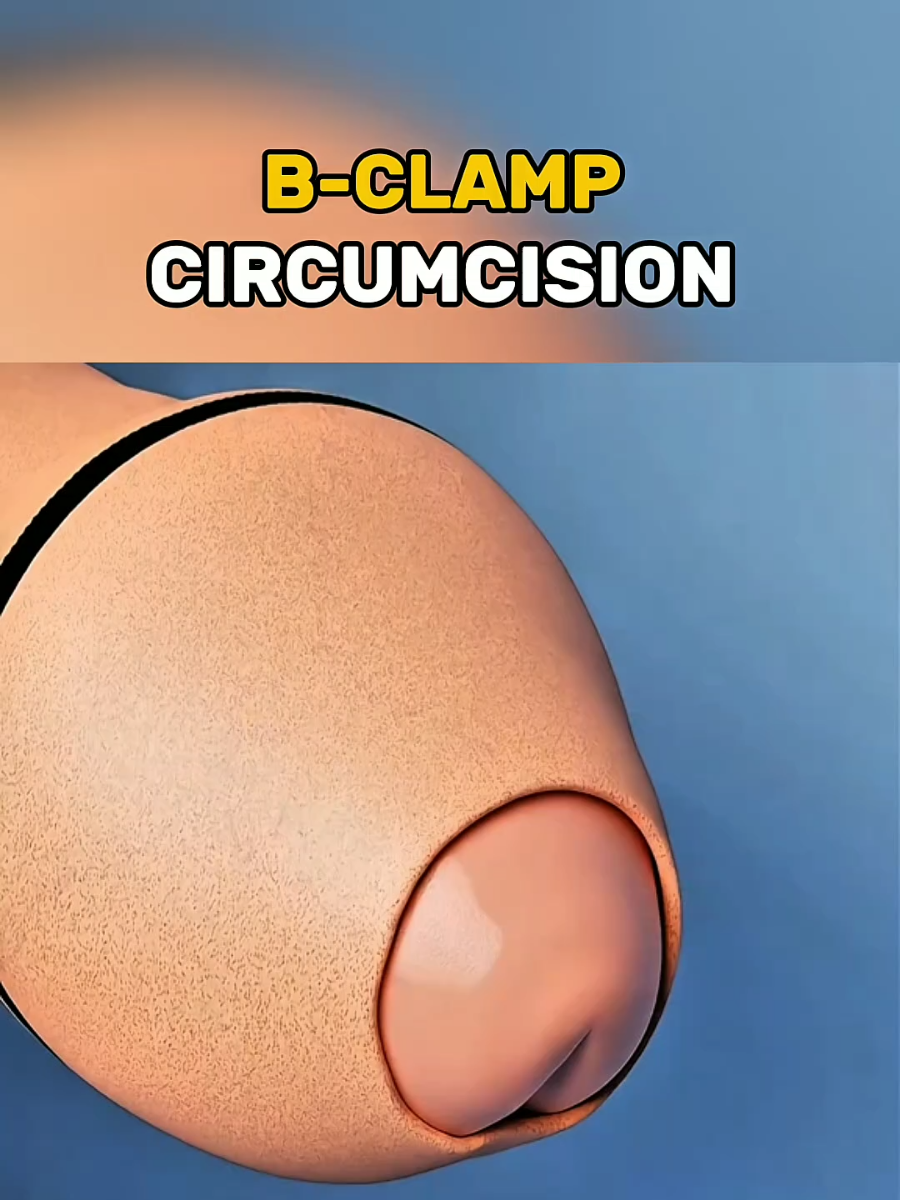 B-CLAMP Circumcision 3d Animations. Modern circumcision is a safe, quick, and minimally invasive procedure designed with advanced techniques for faster healing, less discomfort, and improved hygiene—offering patients confidence and peace of mind. Disclaimer: Educational video for public and young trainees. #bclamp #device #circumcission #medicalanimation #healtheducation 