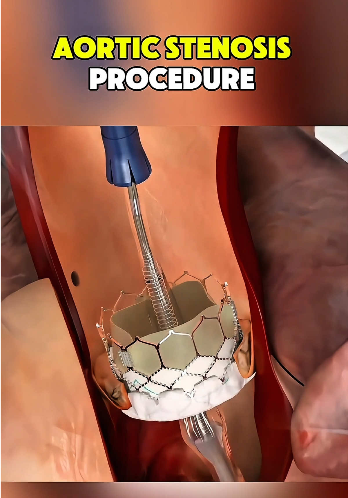 Aortic Stenosis Ever wondered what aortic stenosis is and how it is treated? #AorticStenosis #HeartHealth #Cardiology #HeartValve #TAVR          