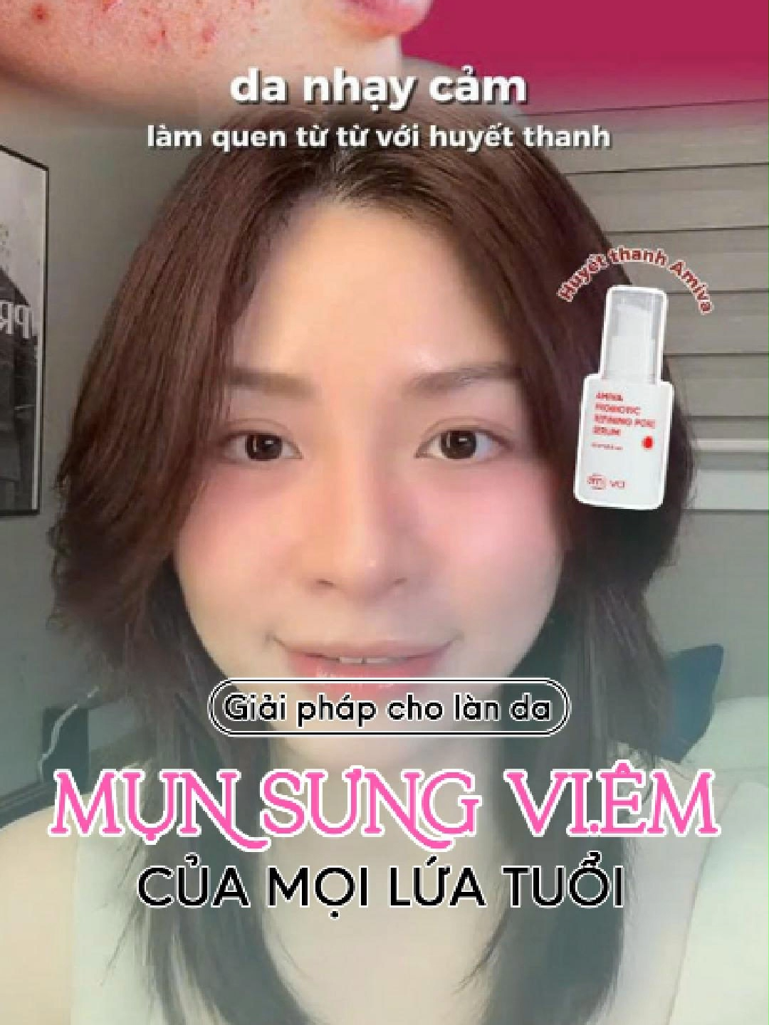 Lỗ chân lông to – serum Amiva có phải “cứu tinh”?Chắc các chị cũng từng thử nhiều cách nhưng vẫn chưa thấy hiệu quả. Serum không phải phép màu, nhưng nếu chọn đúng, dùng đúng, sẽ thấy sự khác biệt. Thành phần như niacinamide, Gluconolactone 3% có thể giúp se khít lỗ chân lông, giảm dầu thừa và làm sáng da. Nhưng quan trọng là phải kiên trì và kết hợp với skincare routine phù hợp. Đừng quên chống nắng và dưỡng ẩm đầy đủ nhé! Nếu các chị đang tìm serum phù hợp, hãy thử những sản phẩm như serum Amiva. Hiệu quả sẽ rõ rệt sau vài tuần sử dụng đều đặn. Chia sẻ với mình tình trạng da của các chị, em sẵn lòng tư vấn thêm ạ #serumamiva#vacuretreat#myphamlevananh #sekhitlochanlong #dadau #chamsocda #skincare