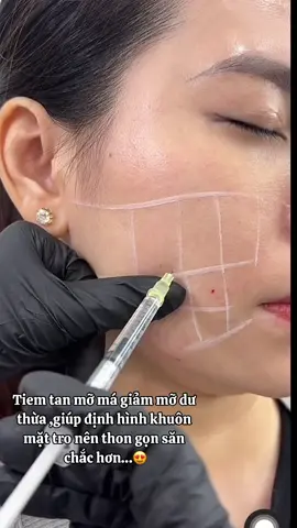 Tiêm tan mỡ má ? #filler #botox  #tiemgiammo #fillerbotoxhanoi #tiemfillerbotoxuytin 