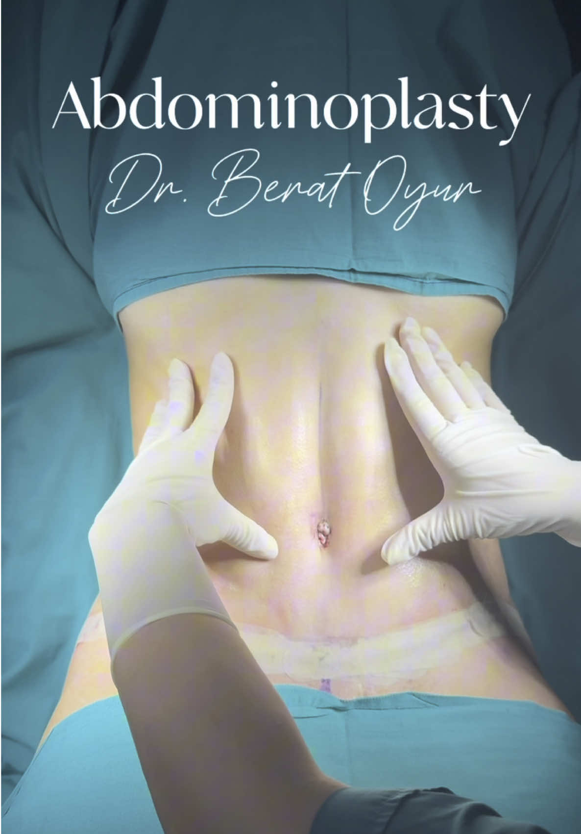 Flat. Firm. Transformed. ✨ Our patient’s abdominoplasty result shows the power of restoring core strength and contour. From before ➝ after: a smoother silhouette and renewed confidence. 🩺💫 #TummyTuck #Abdominoplasty #BeforeAndAfter #BodyContouring #ConfidenceRestored      👩‍⚕️📏